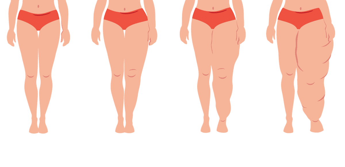 What is Lymphedema  (module 2 of 4)