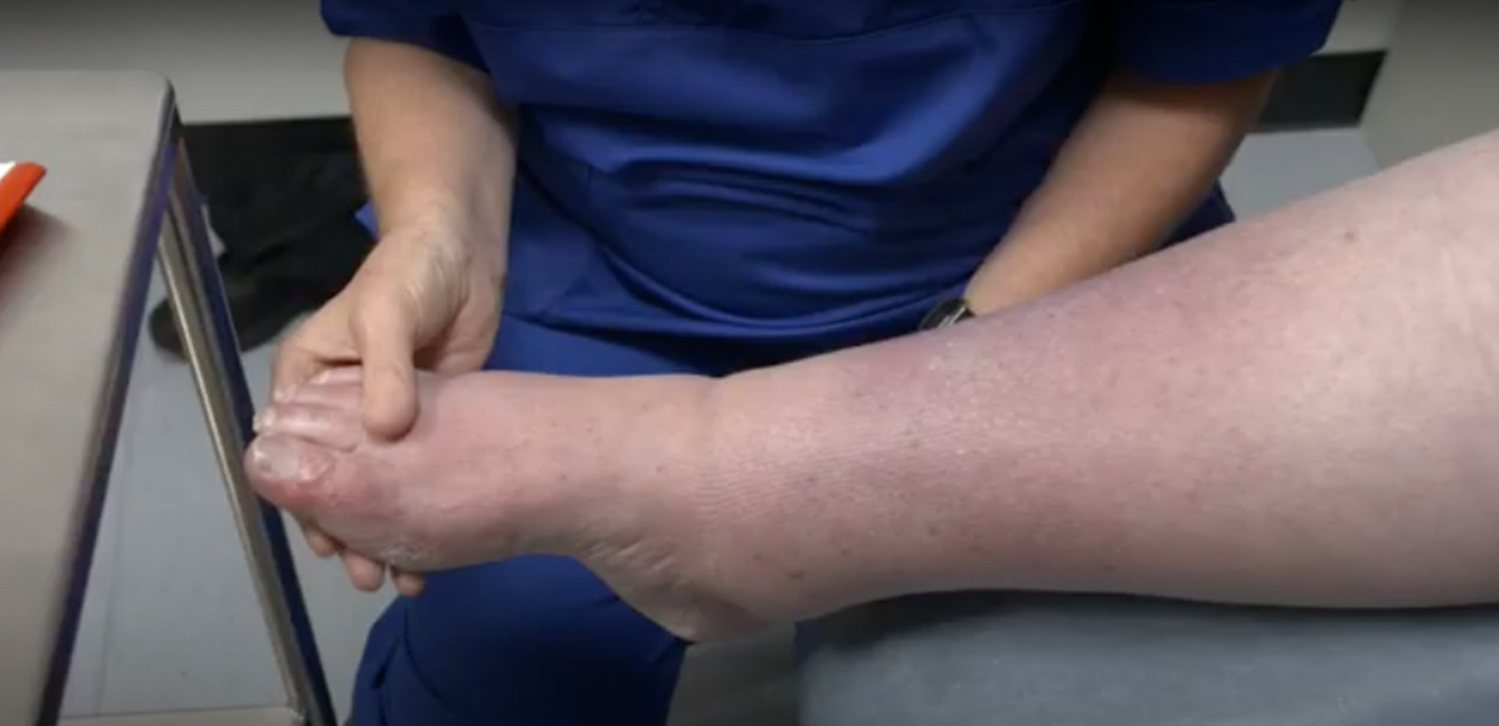 Lymphedema and Self-Management