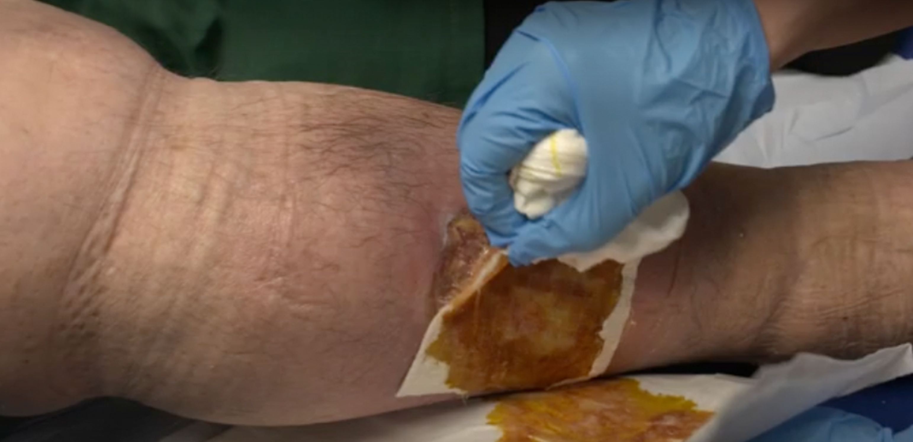 Wounds and Chronic Edema for Health Care Professionals