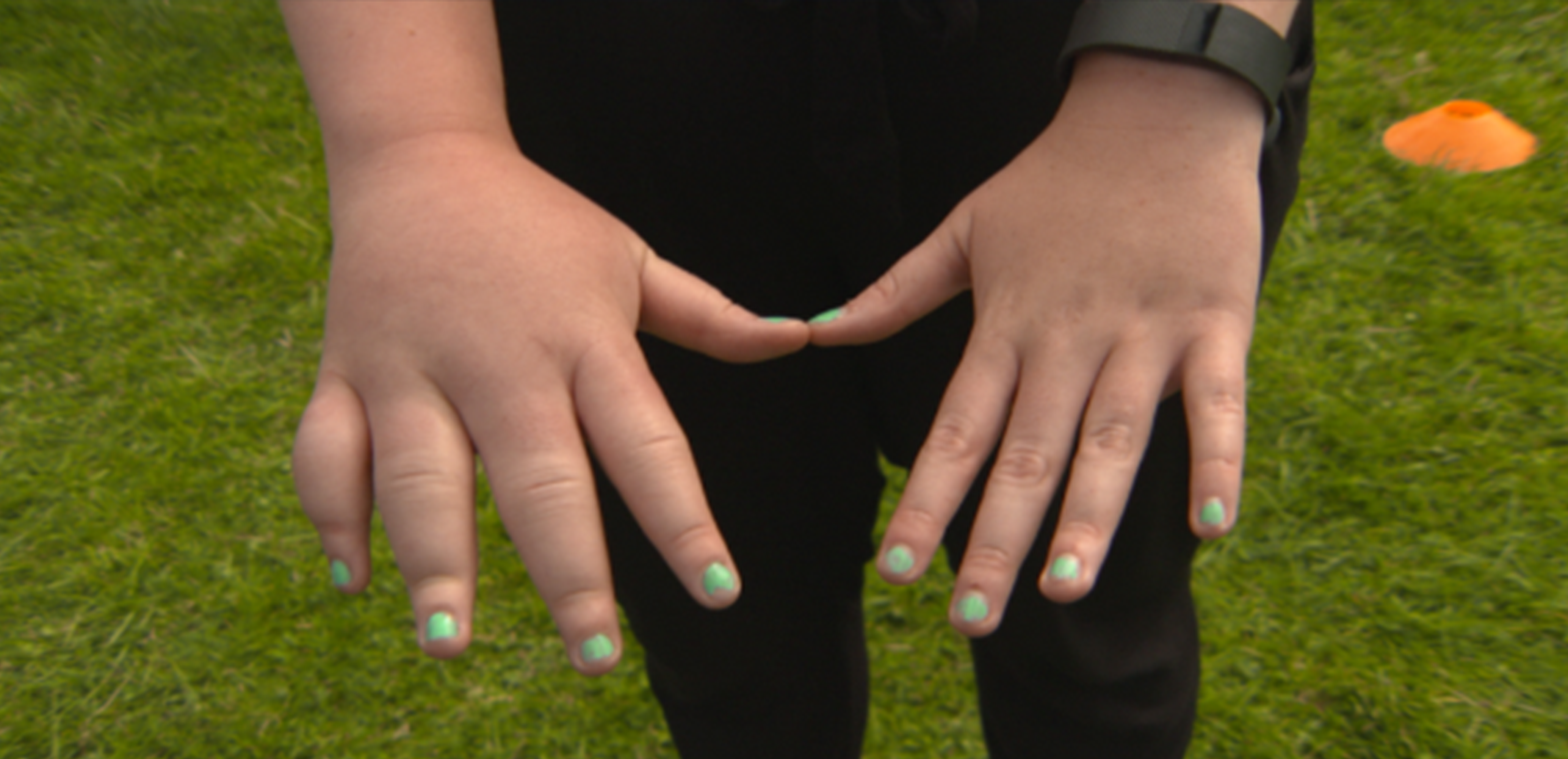 Lymphoedema in Children & Young People