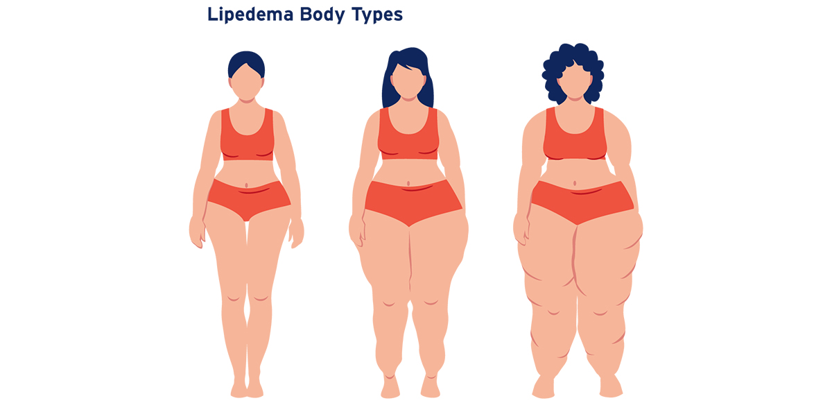 Lipedema (module 1 of 2)