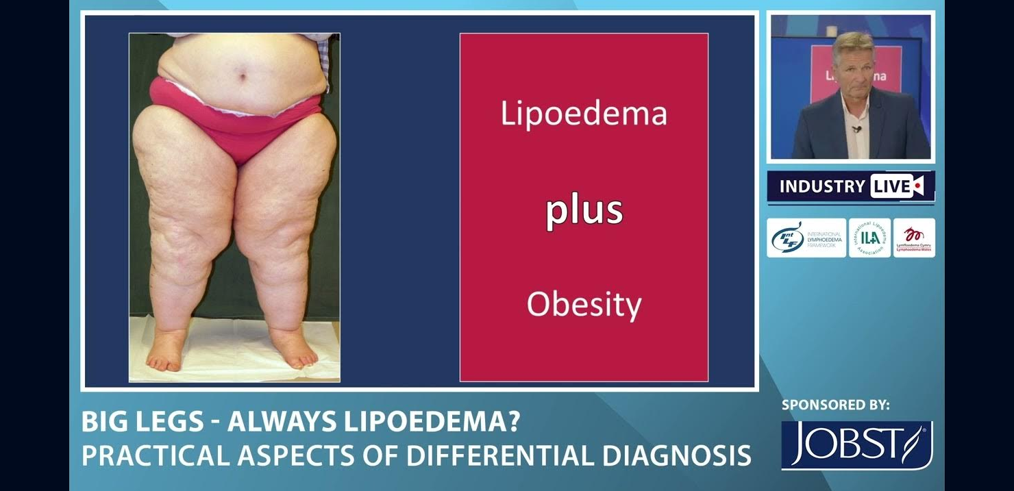 Big Legs - Always Lipoedema? Practical aspects of differential diagnosis
