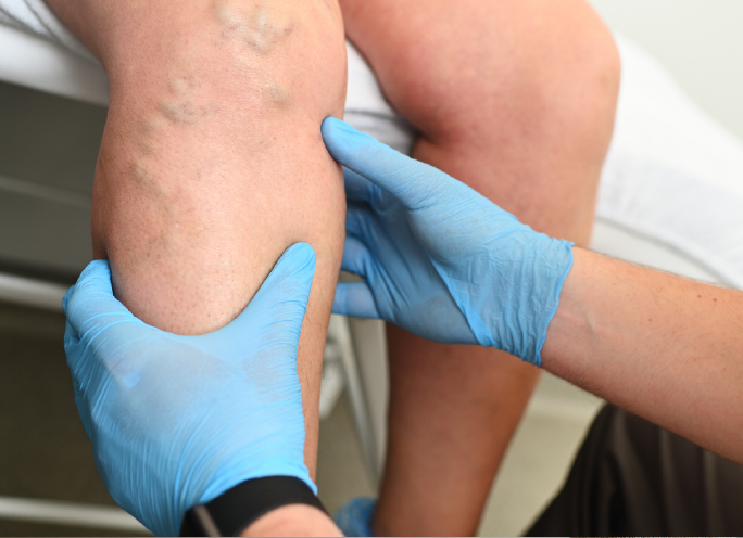 Venous Disease Basics